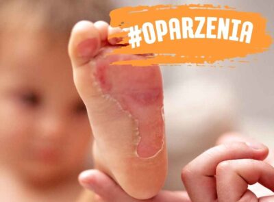 Oparzenia u dzieci – zagrożenie, o którym warto pamiętać.